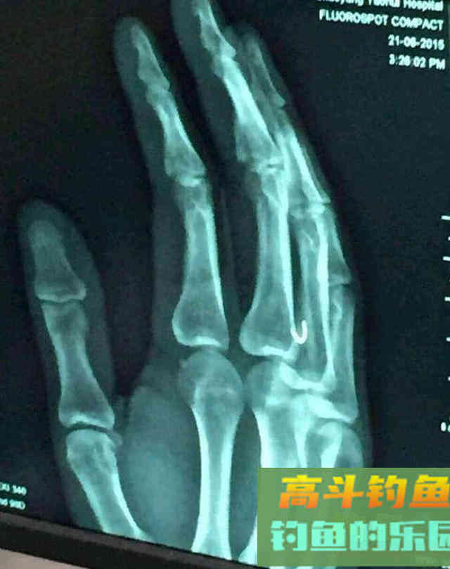 10斤多草鱼把手指伤了值得吗？这次疼入骨髓