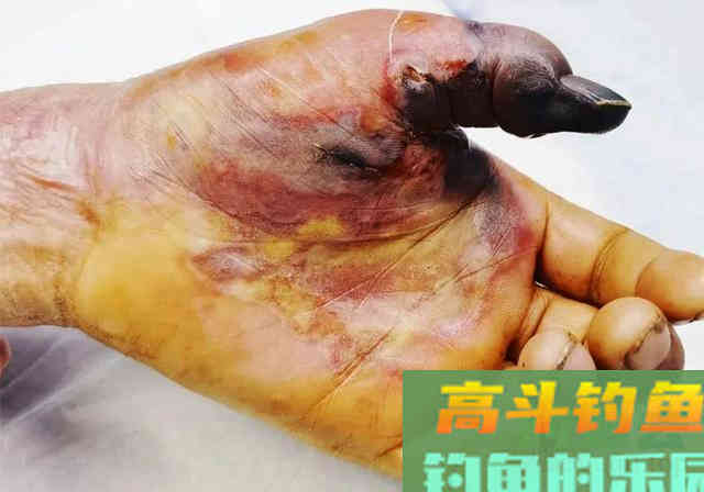 摘钩时被黄辣丁刺伤，指头被截险丧命，详解正确摘鱼方法