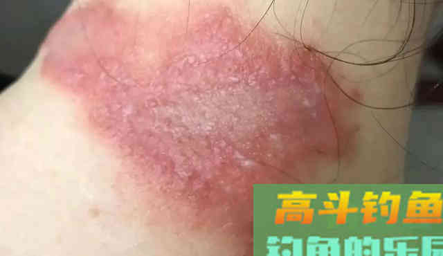 夏天野钓要小心这3种动物，比蚊子狠太多