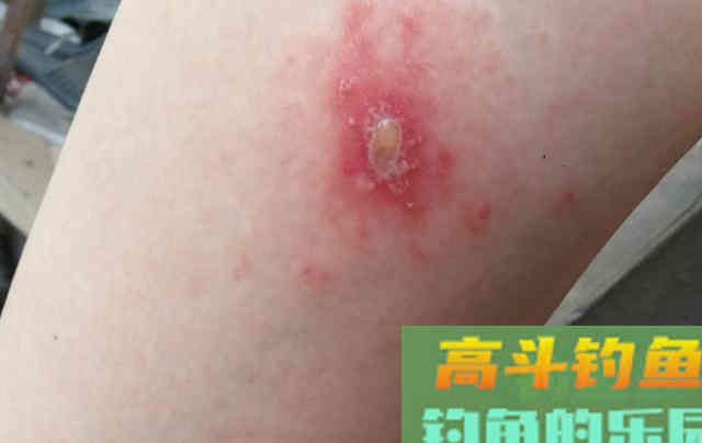 夏季钓鱼要注意，这2个小昆虫对人有致命威胁