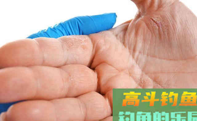 香虎手缘由麦芽酚过敏？别轻信，饵料烧手另有原因